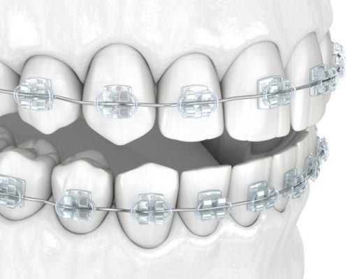 ortodoncja-2